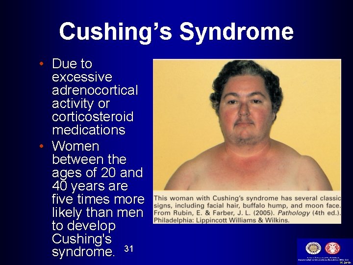 Cushing’s Syndrome • Due to excessive adrenocortical activity or corticosteroid medications • Women between