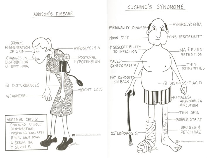 Cushing’s Syndrome 32 