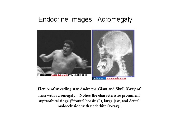 Endocrine Images: Acromegaly Andre the Giant by EKavet (Flickr) acromegaly. org. uk Picture of