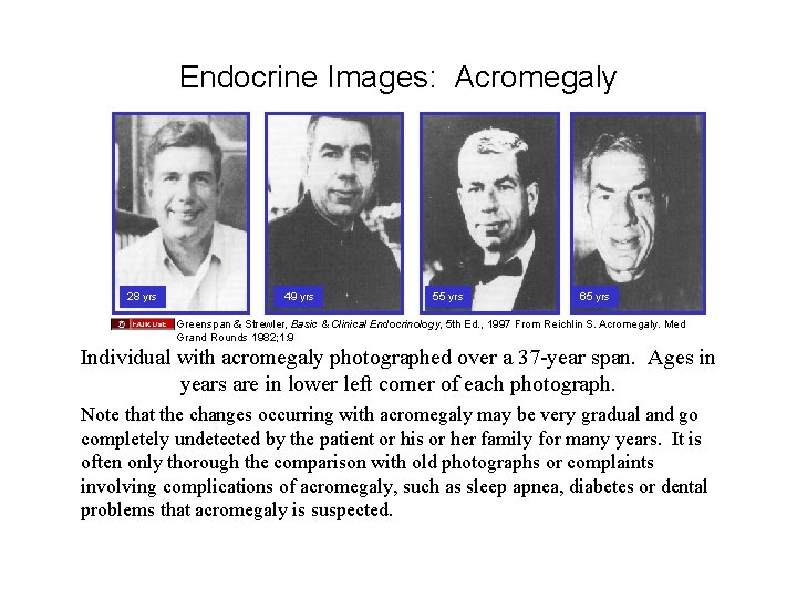 Endocrine Images: Acromegaly 28 yrs 49 yrs 55 yrs 65 yrs Greenspan & Strewler,