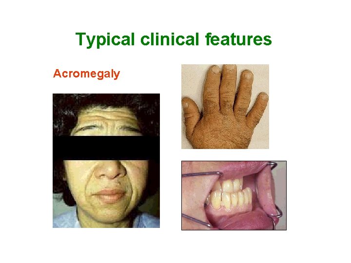 Typical clinical features Acromegaly 