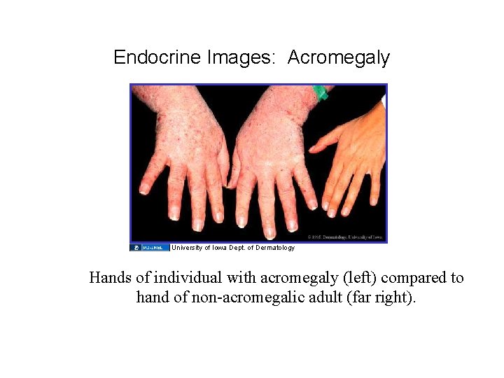 Endocrine Images: Acromegaly University of Iowa Dept. of Dermatology Hands of individual with acromegaly