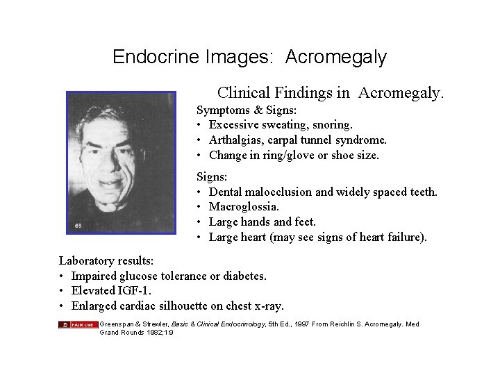 Endocrine Images: Acromegaly Clinical Findings in Acromegaly. Symptoms & Signs: • Excessive sweating, snoring.