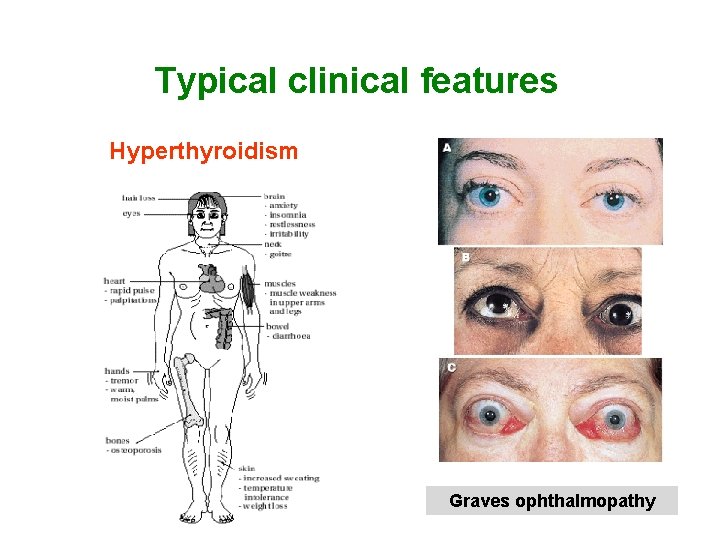 Typical clinical features Hyperthyroidism Graves ophthalmopathy 
