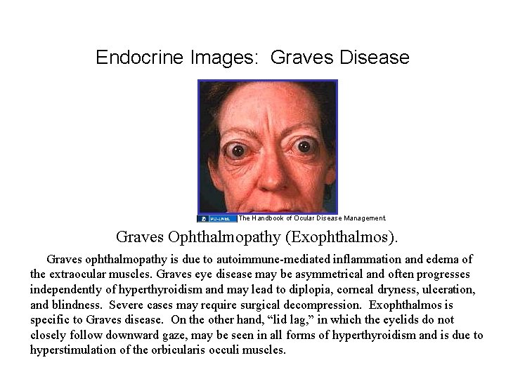 Endocrine Images: Graves Disease The Handbook of Ocular Disease Management. Graves Ophthalmopathy (Exophthalmos). Graves