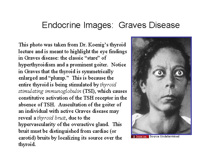 Endocrine Images: Graves Disease This photo was taken from Dr. Koenig’s thyroid lecture and