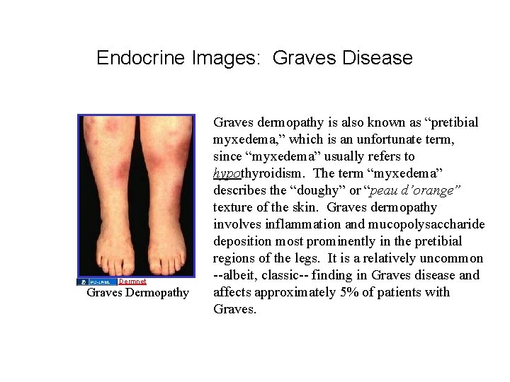 Endocrine Images: Graves Disease Dermnet Graves Dermopathy Graves dermopathy is also known as “pretibial