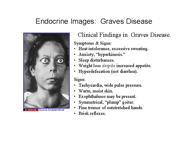 Endocrine Images: Graves Disease Clinical Findings in Graves Disease. Symptoms & Signs: • Heat