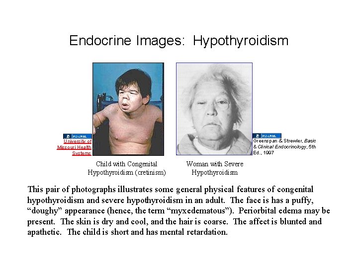 Endocrine Images: Hypothyroidism Greenspan & Strewler, Basic & Clinical Endocrinology, 5 th Ed. ,