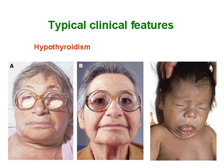 Typical clinical features Hypothyroidism 