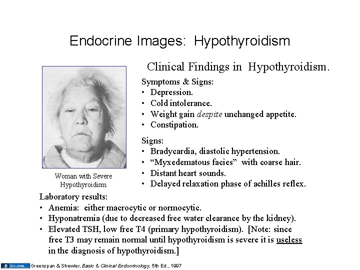 Endocrine Images: Hypothyroidism Clinical Findings in Hypothyroidism. Symptoms & Signs: • Depression. • Cold