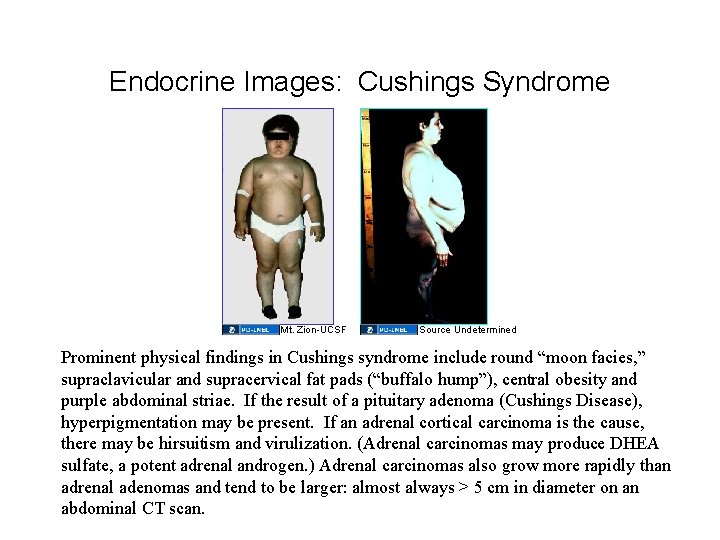 Endocrine Images: Cushings Syndrome Mt. Zion-UCSF Source Undetermined Prominent physical findings in Cushings syndrome