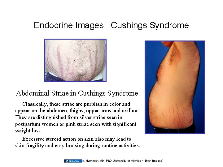 Endocrine Images: Cushings Syndrome Abdominal Striae in Cushings Syndrome. Classically, these striae are purplish