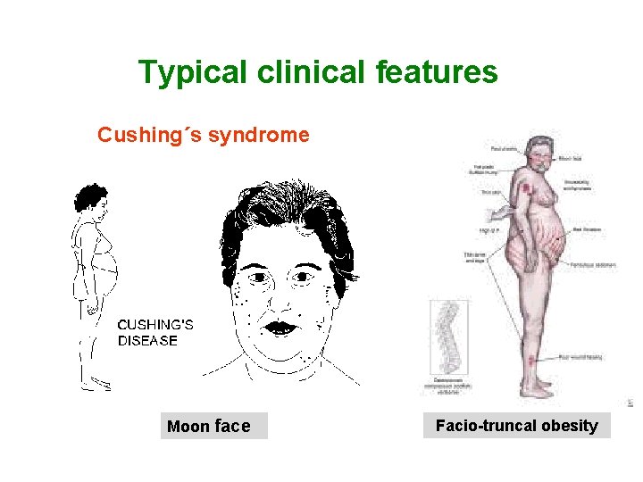Typical clinical features Cushing´s syndrome Moon face Facio-truncal obesity 