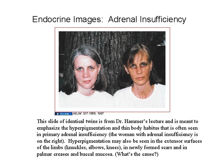 Endocrine Images: Adrenal Insufficiency NEJM 337: 1666, 1997 This slide of identical twins is