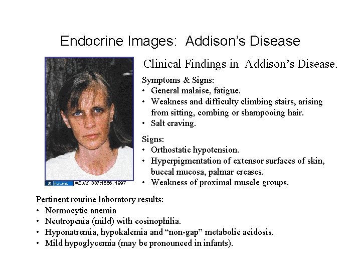 Endocrine Images: Addison’s Disease Clinical Findings in Addison’s Disease. Symptoms & Signs: • General