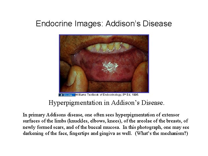 Endocrine Images: Addison’s Disease Williams Textbook of Endocrinology, 8 th Ed, 1996. Hyperpigmentation in