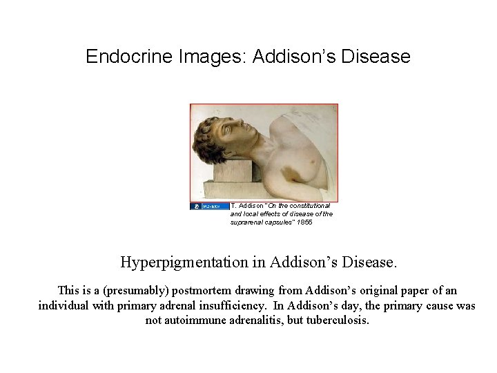 Endocrine Images: Addison’s Disease T. Addison “On the constitutional and local effects of disease