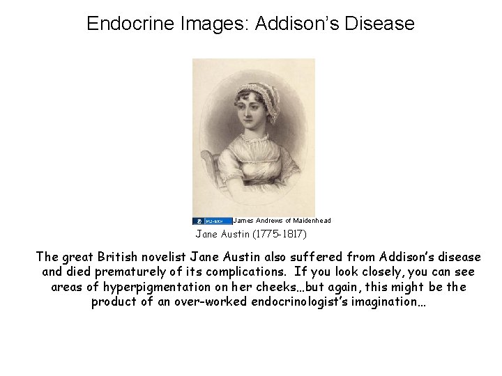 Endocrine Images: Addison’s Disease James Andrews of Maidenhead Jane Austin (1775 -1817) The great