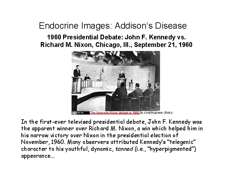 Endocrine Images: Addison’s Disease 1960 Presidential Debate: John F. Kennedy vs. Richard M. Nixon,