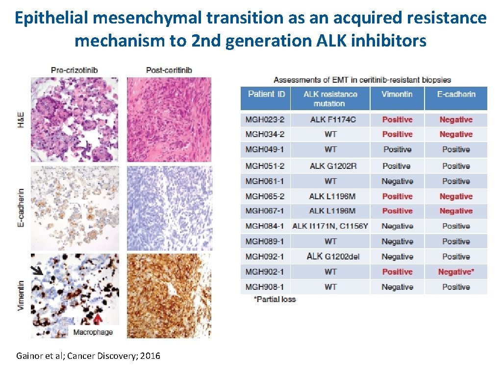 Epithelial mesenchymal transition as an acquired resistance mechanism to 2 nd generation ALK inhibitors