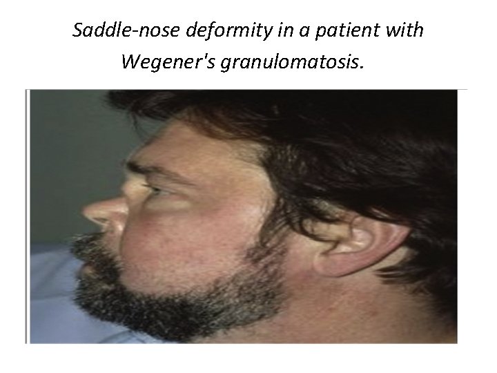 Saddle-nose deformity in a patient with Wegener's granulomatosis. 