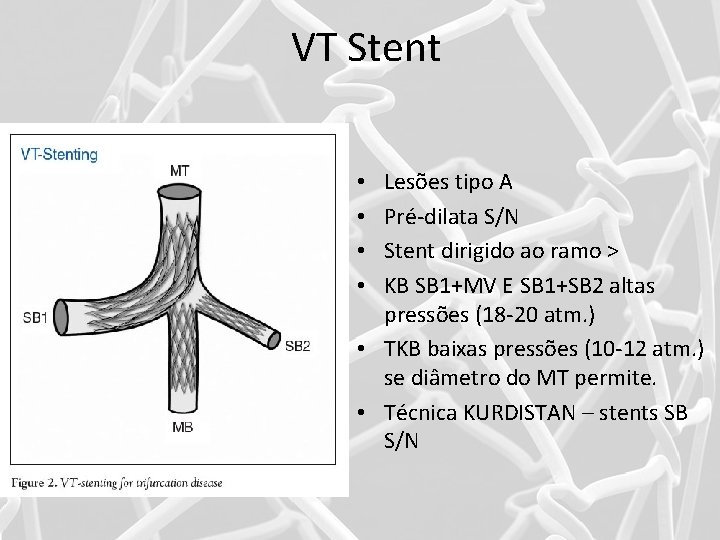 VT Stent Lesões tipo A Pré-dilata S/N Stent dirigido ao ramo > KB SB