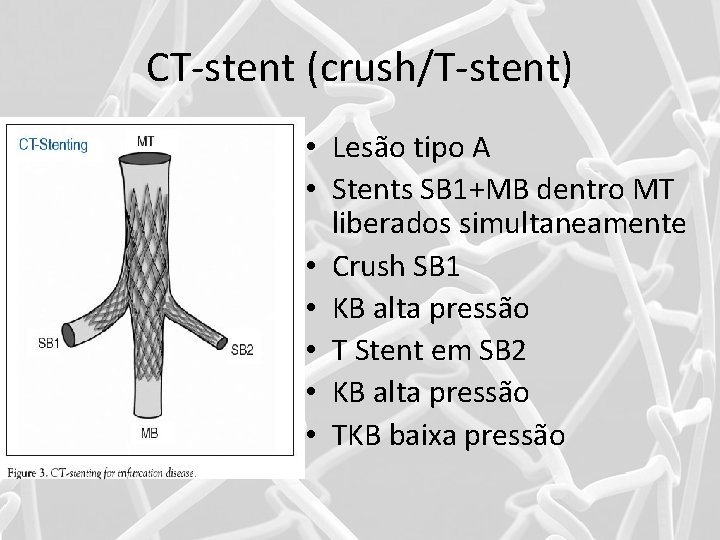 CT-stent (crush/T-stent) • Lesão tipo A • Stents SB 1+MB dentro MT liberados simultaneamente