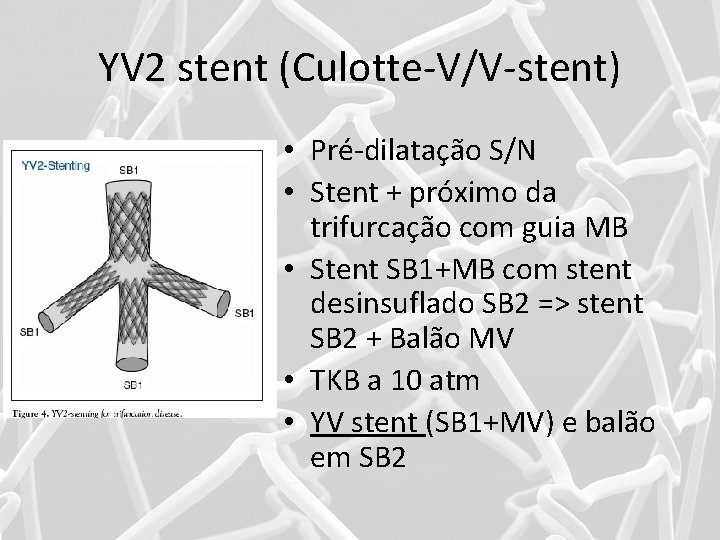 YV 2 stent (Culotte-V/V-stent) • Pré-dilatação S/N • Stent + próximo da trifurcação com