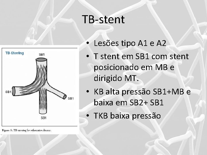 TB-stent • Lesões tipo A 1 e A 2 • T stent em SB