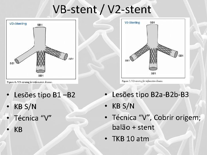 VB-stent / V 2 -stent • • Lesões tipo B 1 –B 2 KB