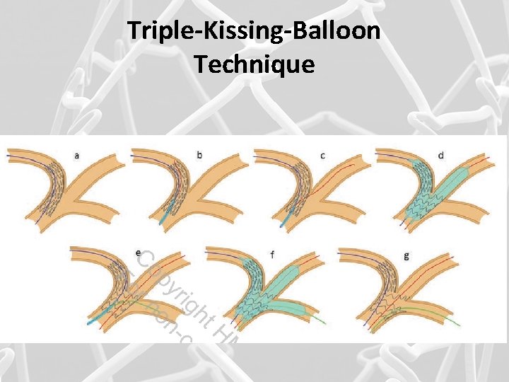 Triple-Kissing-Balloon Technique 