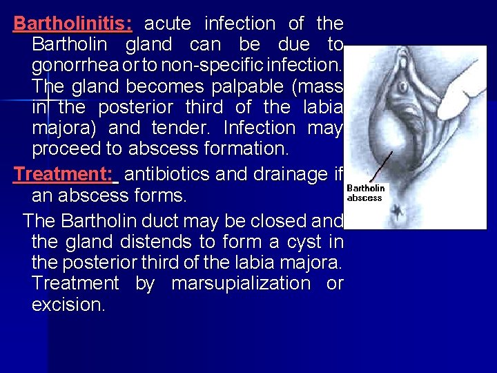 Bartholinitis: acute infection of the Bartholin gland can be due to gonorrhea or to