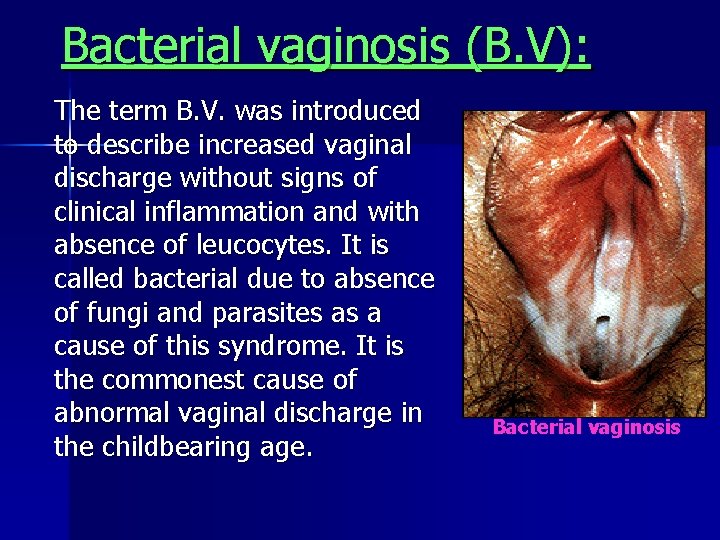 Bacterial vaginosis (B. V): The term B. V. was introduced to describe increased vaginal