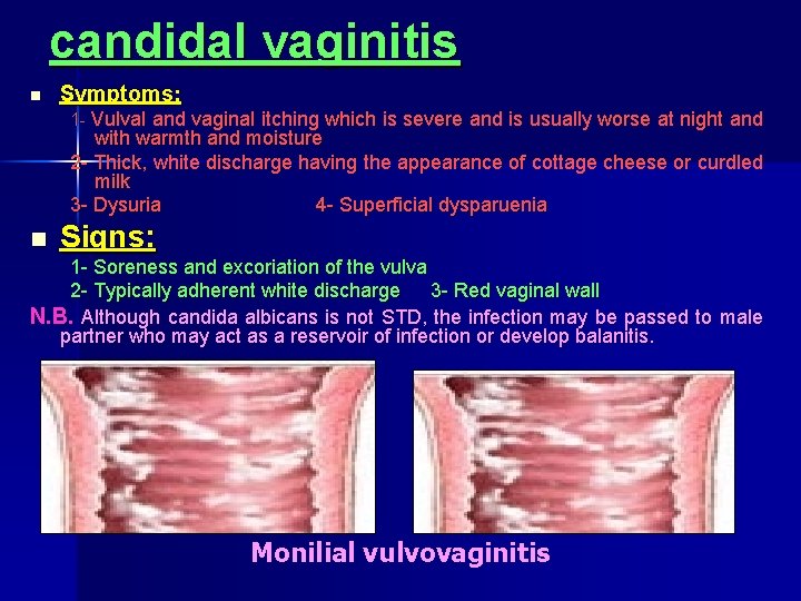 candidal vaginitis n Symptoms: 1 Vulval and vaginal itching which is severe and is