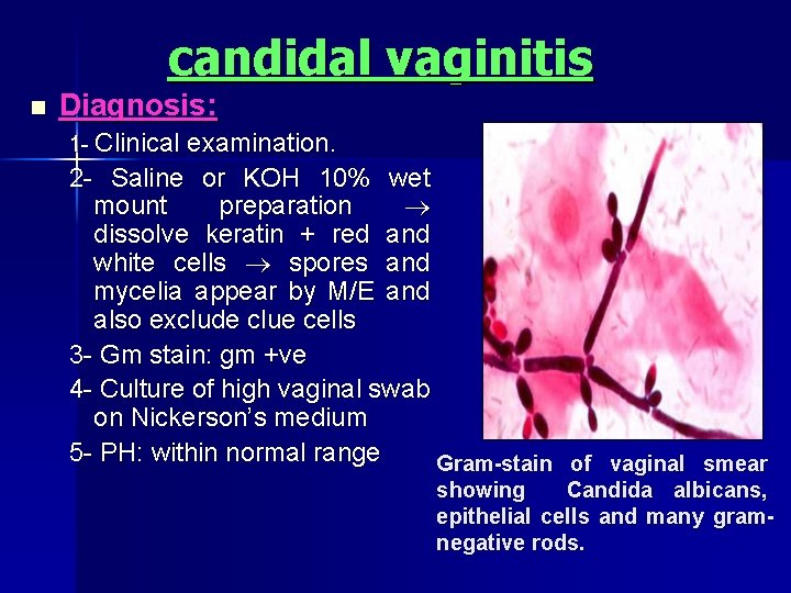 candidal vaginitis n Diagnosis: 1 Clinical examination. 2 Saline or KOH 10% wet mount