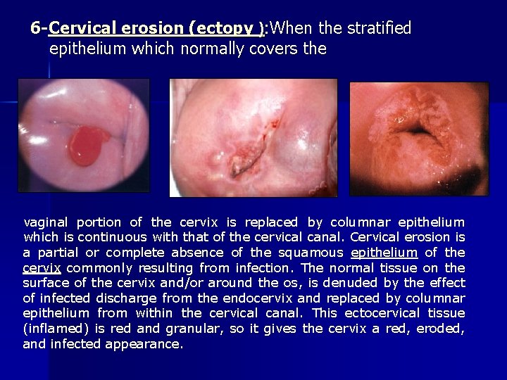 6 -Cervical erosion (ectopy ): When the stratified epithelium which normally covers the vaginal