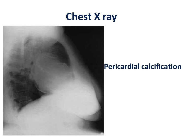 Chest X ray Pericardial calcification 