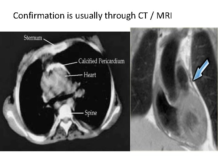 Confirmation is usually through CT / MRI Confirmation is usually through CT / MRI