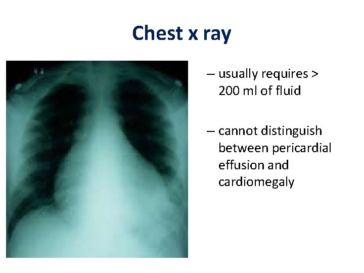 Chest x ray – usually requires > 200 ml of fluid – cannot distinguish