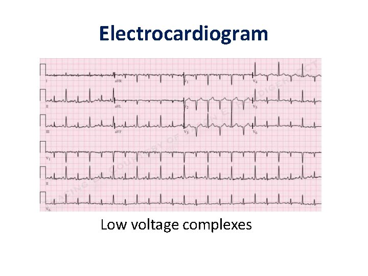 Electrocardiogram Low voltage complexes Electrocardiogram Low voltage complexes