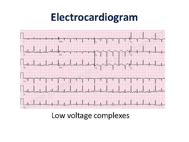 Electrocardiogram Low voltage complexes 