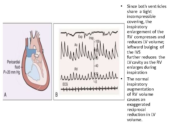  • Since both ventricles share a tight incompressible covering, the inspiratory enlargement of