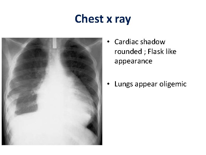 Chest x ray • Cardiac shadow rounded ; Flask like appearance • Lungs appear