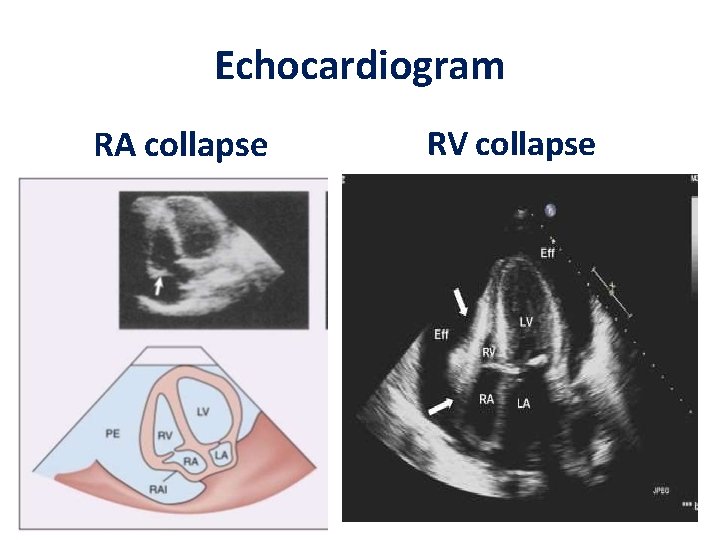 Echocardiogram RA collapse RV collapse 