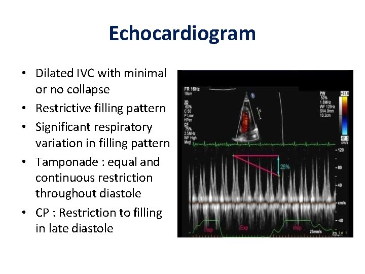 Echocardiogram • Dilated IVC with minimal or no collapse • Restrictive filling pattern • Echocardiogram • Dilated IVC with minimal or no collapse • Restrictive filling pattern •