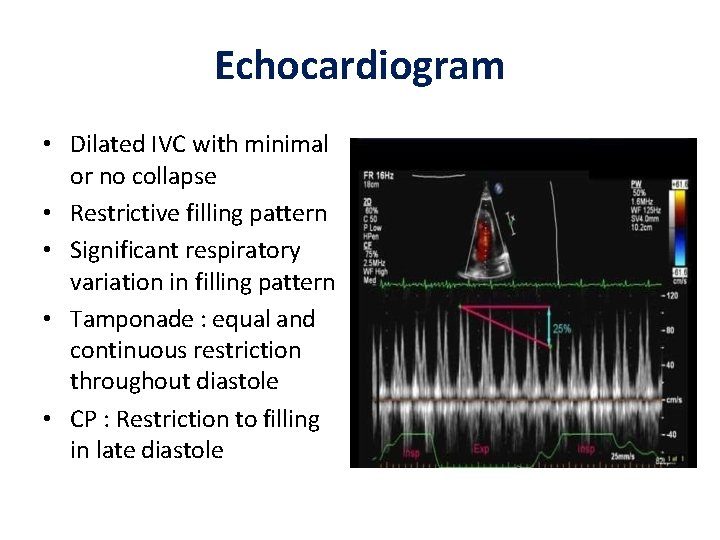 Echocardiogram • Dilated IVC with minimal or no collapse • Restrictive filling pattern •