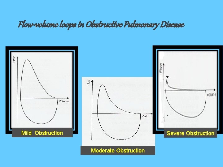 Flow-volume loops in Obstructive Pulmonary Disease PEF PIF Mild Obstruction Severe Obstruction Moderate Obstruction
