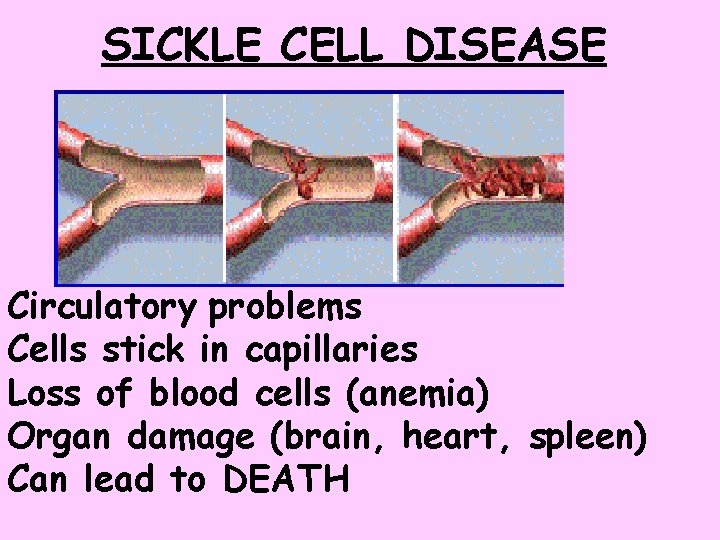 SICKLE CELL DISEASE Circulatory problems Cells stick in capillaries Loss of blood cells (anemia)