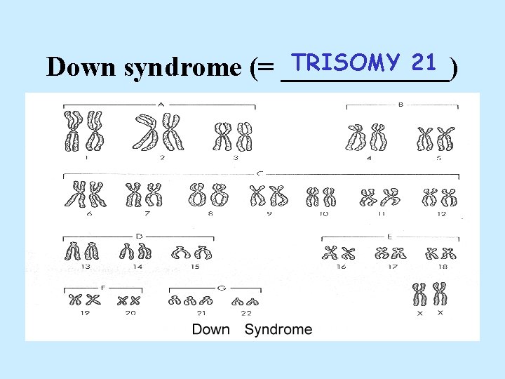 TRISOMY 21 Down syndrome (= ______) 